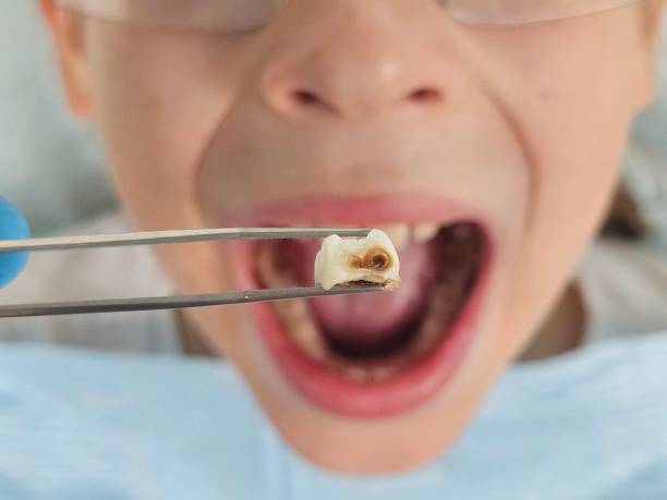 Best Emergency Dental Care for Broken or Chipped Teeth in Skyline, AL